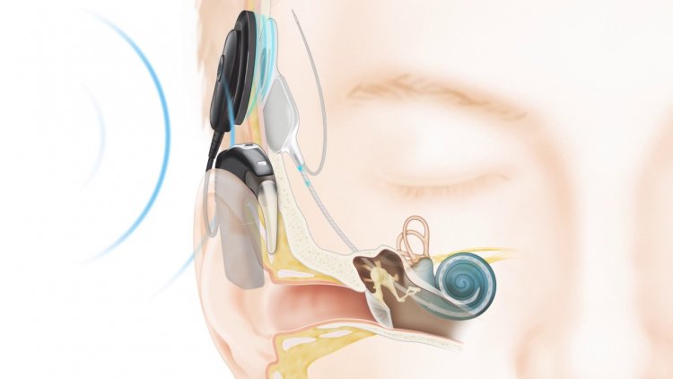 The cochlear implant