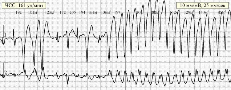 Rhythm disturbances in patients with arrhythmogenic cardiomyopathy of the right ventricle with a high risk of sudden cardiac death