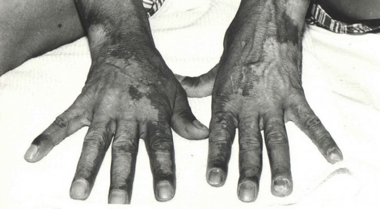 Radiation burns on the hands of a victim of the Chernobyl accident, 1986. Photo: https://fmbafmbc.ru/about/about-the-center/the-history-of-the-centre/