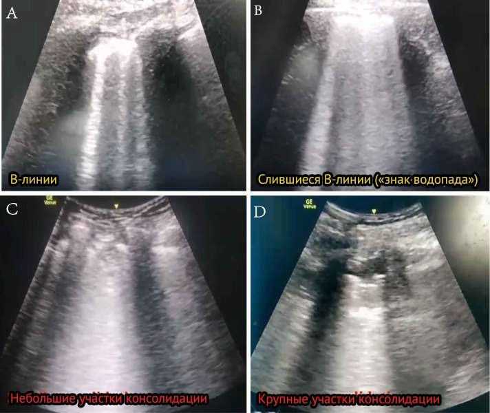 Ultrasound lung examination in case of COVID-19