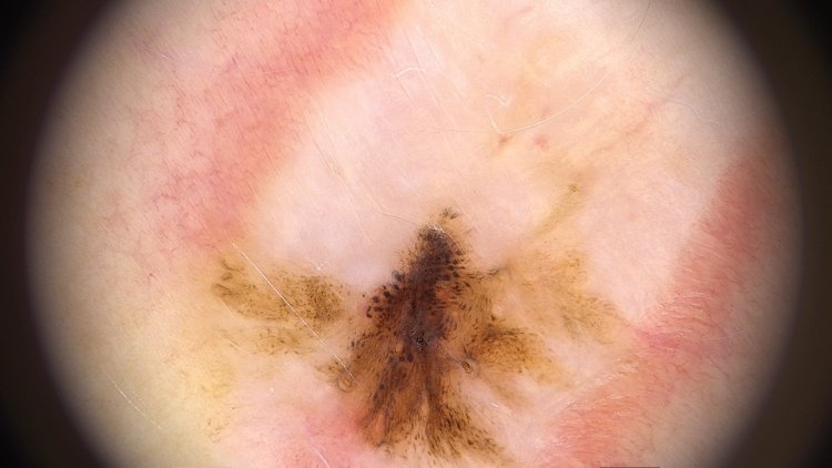 Recurrence of melanocytic nevus in the scar. Dermatoscopic picture. Magnification x20