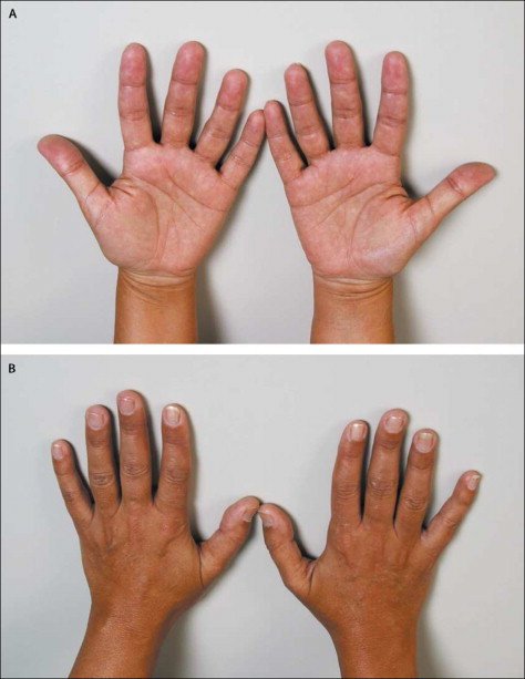Typical hyperpigmentation of Addison's disease localised to (A) palmar creases and (B) knuckles